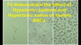 Hemoglobin BreakdownMetabolism [upl. by Anilys]