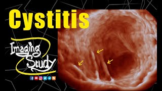 Cystitis  Ultrasound  3D  Case 228 [upl. by Boland]