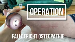 Operation des Sprunggelenks  osteochondrosis dissecans Falllbericht [upl. by Esinahs]