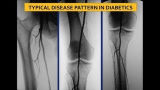 UCSF Vascular Surgery Symposium  Screening for Ischemia in the Diabetic Foot [upl. by Otsugua]