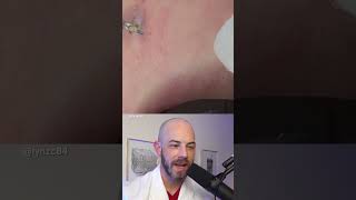 Derm reacts to huge blackhead extraction dermreacts doctorreacts blackhead [upl. by Abrams]