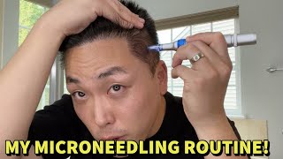 MY MICRONEEDLING ROUTINE TO TREAT HAIR LOSS [upl. by Ttelrats953]