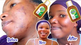 HOW TO USE DETTOL ANTISEPTIC LIQUID TO TREAT PIMPLES  ACNE DARK SPOTS SCARS amp HYPERPIGMENTATION [upl. by Jacobba]