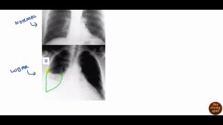 Community Acquired Pneumonia for USMLE Step 2 [upl. by Llenaj242]