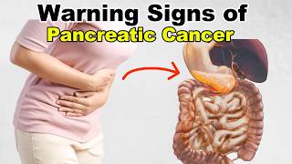 10 Warning Signs of Pancreatic Cancer  How to Reduce the Risk [upl. by Acirretahs]