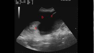 Ecografía pulmonar derrame pleural [upl. by Mars]