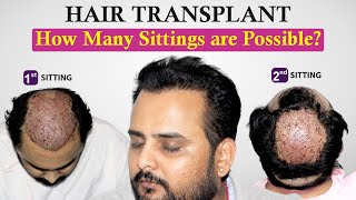 HOW Many Hair Transplant Sittings are Possible Hair Transplant in India  Dr Suneet  Medispa India [upl. by Buhler]