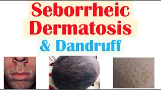 Seborrheic Dermatitis Dandruff and Cradle Cap Causes Risk Factors Symptoms Diagnosis Treatment [upl. by Reneta87]