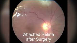 Retinal Detachment Surgery advancedretinacare [upl. by Nythsa]