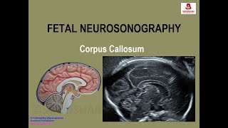 Fetal Neurosonography – Corpus Callosum [upl. by Evers]