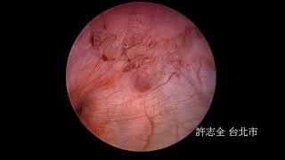 膀胱癌內視鏡，移形上皮細胞癌台北市愛心動物醫院malignant bladder tumor in a dog Charless Veterinary Hospital Taipei [upl. by Anitnauq338]