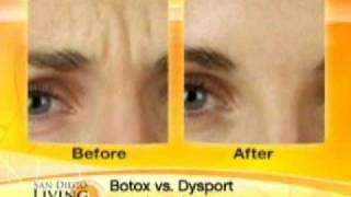 BOTOX VS DYSPORT [upl. by Zilevi]