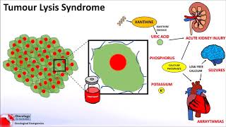 Tumour Lysis Syndrome [upl. by Amliv274]