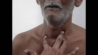 Tracheal palpation  Insinuation method video only [upl. by Heck]