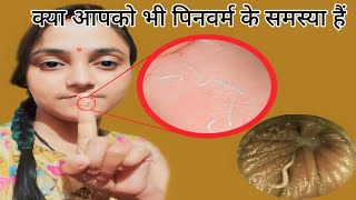 सिर्फ 1 रात मे Pinworms होगा खत्म  How to get rid of Pinworms  Threadworms treatment at home [upl. by Diraj447]