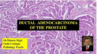 Ductal adenocarcinoma of the prostate [upl. by Braswell]