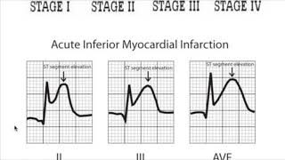 Myocardial Infarction Vs Ac Pericarditis amp Dressler syndrome [upl. by Nitz]