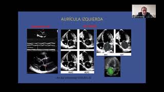 Ecocardiografia en la predicción de embolismo y recurrencia de la FA  Carlos Javier Ramirez [upl. by Finbar]