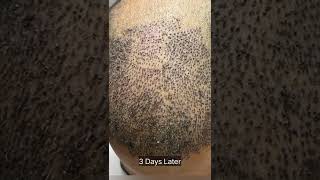 First 7 days of Hair Transplant From Scabs to All Clear [upl. by Ahsercul]