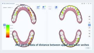 Intraoral Scanner New Function——Orthodontic Simulation [upl. by Anaoj168]