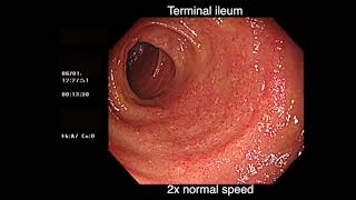 DEEP BACKWASH ILEITIS AND ULCERATIVE COLITIS [upl. by Einoj465]