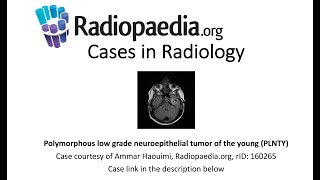 Polymorphous low grade neuroepithelial tumor of the young PLNTY Radiopaediaorg Cases in Radiology [upl. by Rodie678]