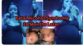 Understanding the Impact Fetal Alcohol Syndrome and Potential Paralysis in Chrisean Son Jr [upl. by Maisey]