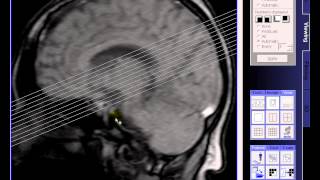 Brain MRI Diperiventrikulerlacunar infarction left ventricular lateral [upl. by Anastasius648]