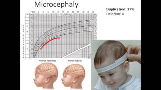 16p112 Neurological Findings [upl. by Eellek]