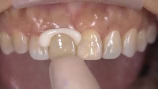 How to Use Kerr Nexus RMGI Resin Modified Glass Ionomer Cement [upl. by Batchelor87]