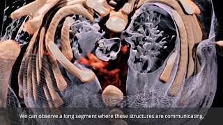 Anatomage Table Patient Case 302 Laryngotracheal Esophageal Cleft [upl. by Ier]