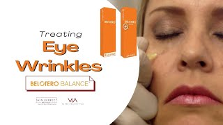 Eye Wrinkle Removal with Belotero Filler  Skin Perfect Los Angeles Area [upl. by Ardnaeed527]