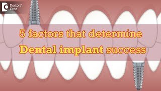 5 factors that determine Dental implant success  Dr Manesh Chandra Sharma [upl. by Langbehn]