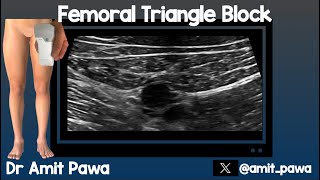 Femoral Triangle Block [upl. by Molini]