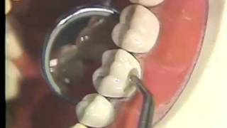 Packing and Carving of Class I and V Amalgam for Hygienists [upl. by Lienahs]