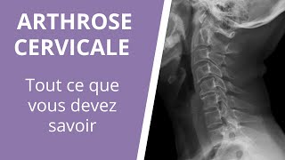 Tout ce que vous devez savoir sur larthrose cervicale  causes symptômes et traitements [upl. by Tillio]