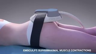 Emsculpt MOA for noninvasive butt lift [upl. by Nedroj943]