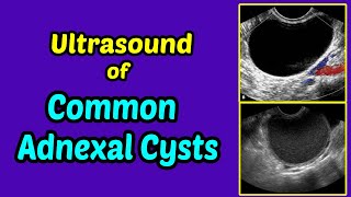 Ultrasound of Common Adnexal Cysts [upl. by Watts817]