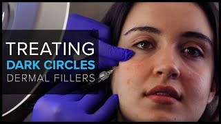 Treating Dark UnderEye Circles With Dermal Fillers at Mabrie Facial Institute [upl. by Nnylecoj]