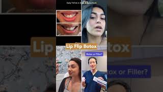 botox lip flip before and after [upl. by Batchelor]