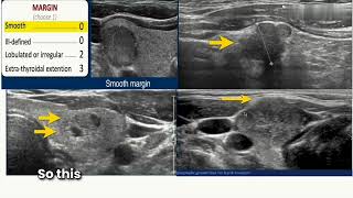 How to calculate TIRADS score for thyroid lesion Thyroid Ultrasound Part II [upl. by Novyak]