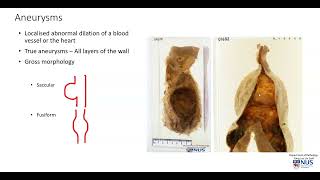 Aorta Aneurysm Gross pathology [upl. by Beora146]