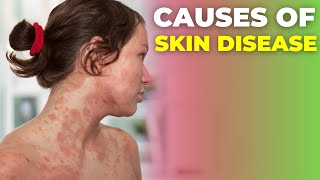 The MOST Common Deficiency in All Skin Diseases Dermatitis [upl. by Smiga102]