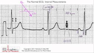 Interval Measurements 64  ECG  EKG Interpretation  BASIC [upl. by Htepsle]