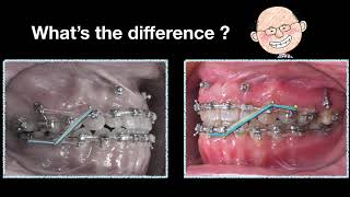 Use of Elastics and Space Generation in Midline Correction｜【Chris Chang Ortho】CC489 [upl. by Welton]