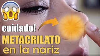 Retiro de METACRILATO de la NARIZ 👃🏼 RINOPLASTÍA 😱 Complicaciones del METACRIL 🤩 Dr ALBERTO CALVO [upl. by Tomlinson]