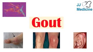 Gout  Causes Pathophysiology Risk Factors ex Diet Symptoms Diagnosis Treatment [upl. by Rafat]