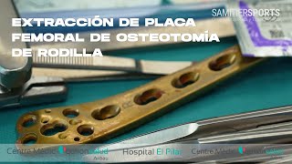 EXTRACCIÓN DE PLACA FEMORAL DE OSTEOTOMÍA DE RODILLA [upl. by Lunneta374]