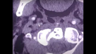 Thrombosis of the internal carotid and middle cerebral artery leading to stroke  CT findings [upl. by Lyons]