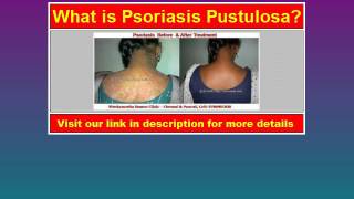 Psoriasis Pustulosa the video for definition of Psoriasis Pustulosa [upl. by Avril]